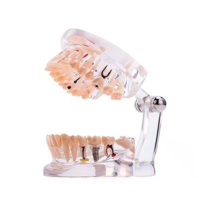 32 Diş Tam Ağız İmplant Hastalıklı Diş Modeli Şeffaf Tasarım Diş Patoloji Modeli